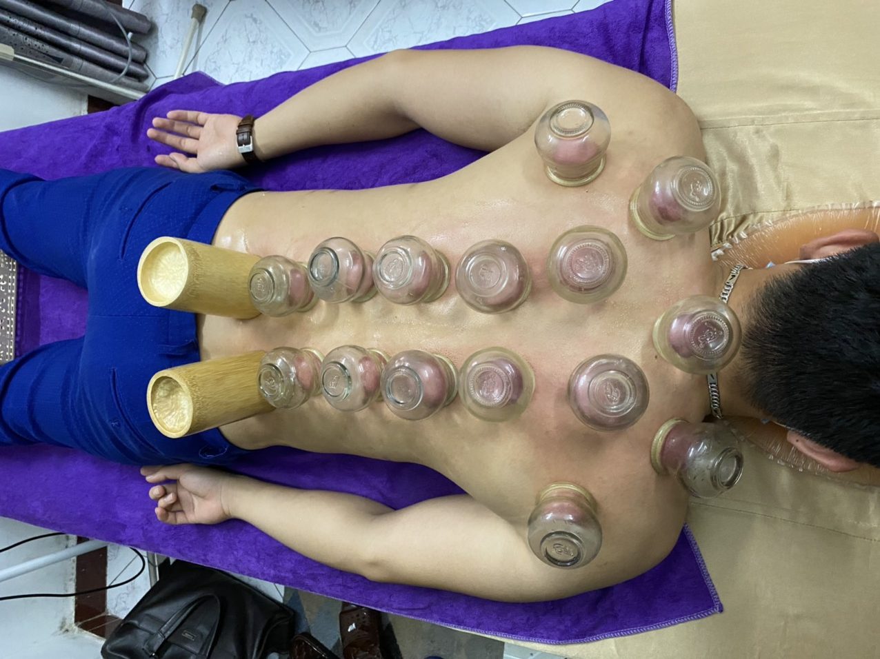 Giác Hơi Cạo Gió phương pháp phòng và trị bệnh tuyệt vời