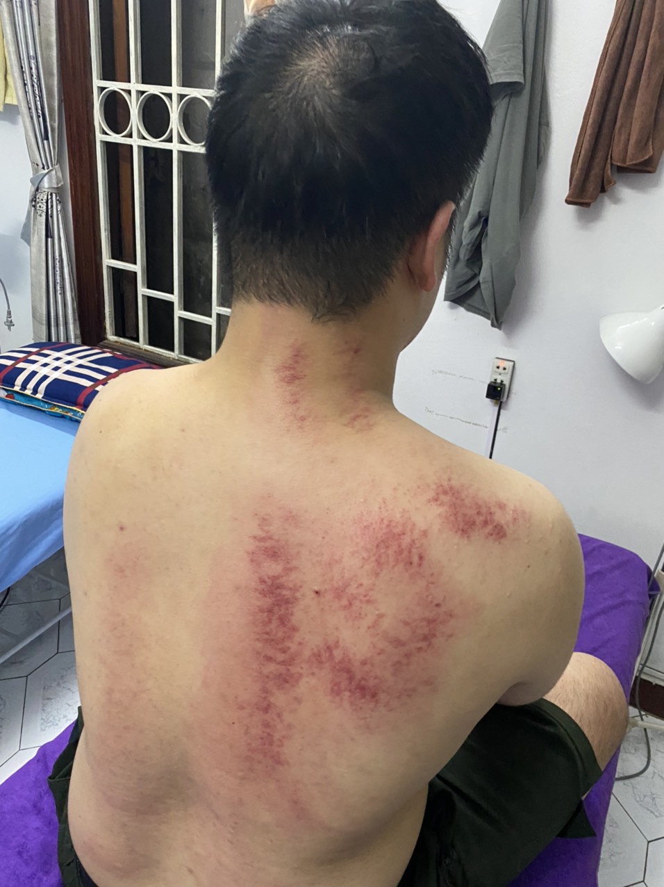 Phong Thấp Khớp ????